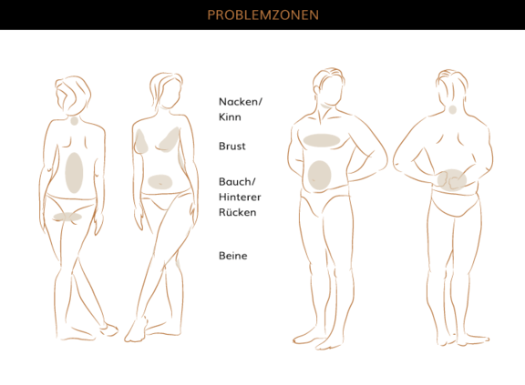 Fettabsaugung, Plastische & Ästhetische Chirurgie Augsburg, AEZA