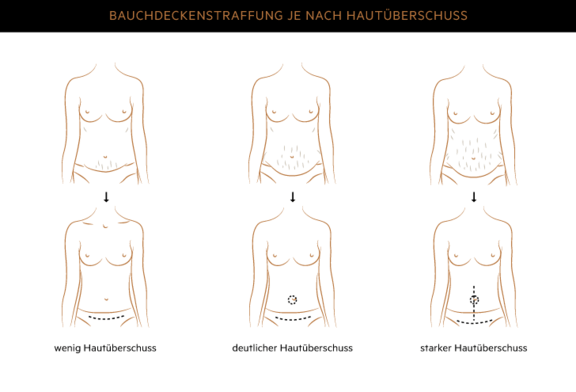 Bauchdeckenstraffung, Plastische & Ästhetische Chirurgie Augsburg, AEZA