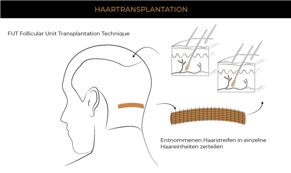 Haartransplantation FUT Methode, Plastische & Ästhetische Chirurgie Augsburg, AEZA
