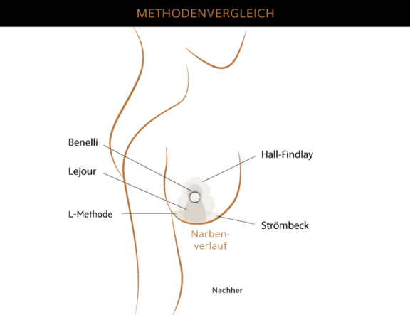 Methoden Bruststraffung, Plastische & Ästhetische Chirurgie Augsburg, AEZA