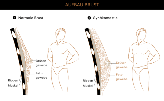 Gynäkomastie, Plastische & Ästhetische Chirurgie Augsburg, AEZA