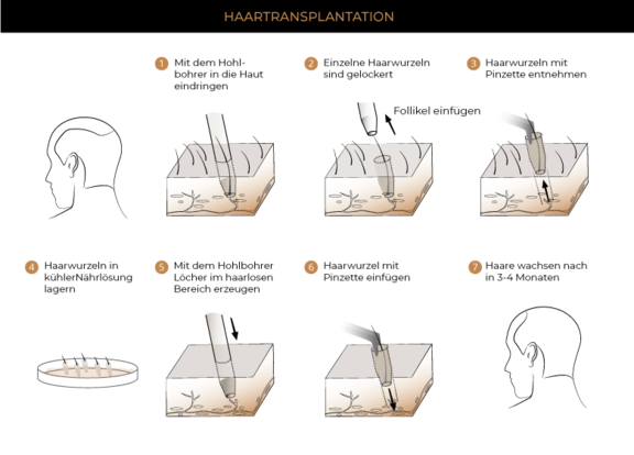 Haartransplantation FUE, Plastische & Ästhetische Chirurgie Augsburg, AEZA