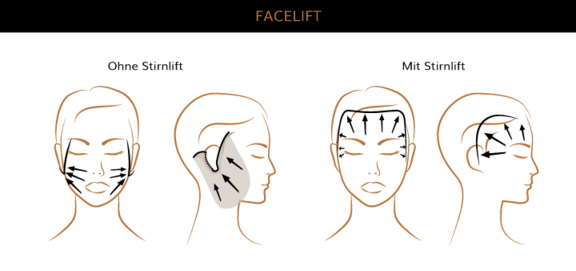 Facelift, Plastische & Ästhetische Chirurgie Augsburg, AEZA